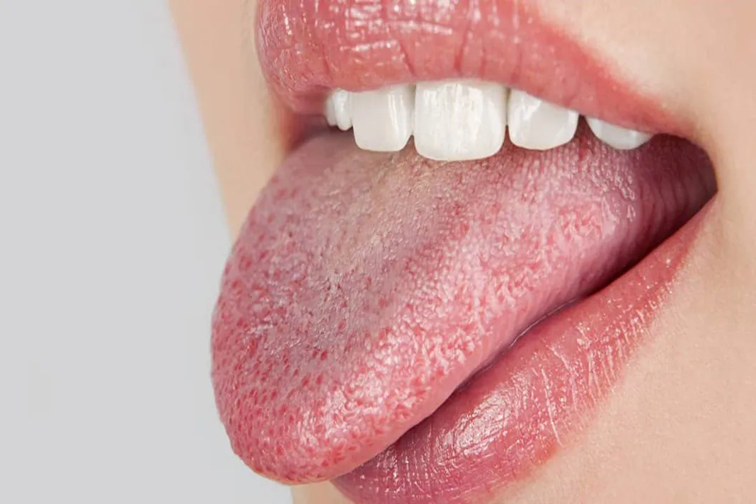 How to Identify and Manage Medication-Induced Xerostomia